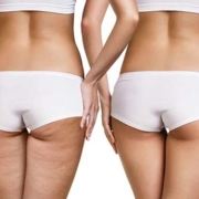 Cellulite in forma per l'estate