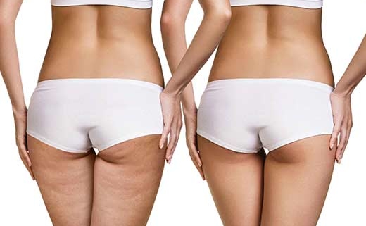 Cellulite in forma per l'estate